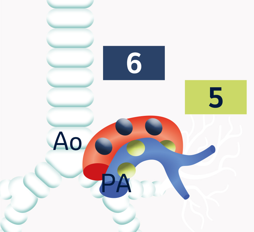 TNM lungcancer - Aortazonen, vy
över ventral